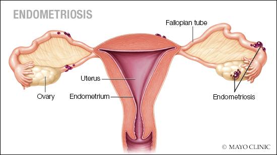 Penyakit endometriosis disebabkan oleh